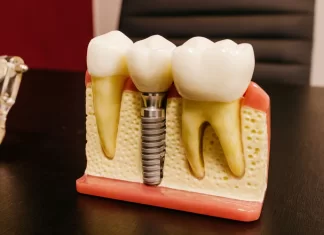 piotrowscybejnarowicz.pl - 037-jak-wyglada-zabieg-implantacji-natychmiastowej-w-gliwicach.webp