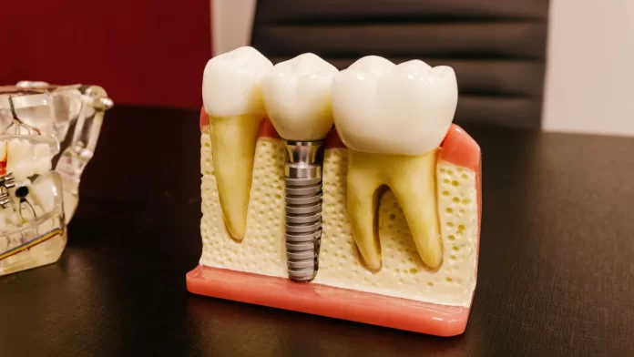 piotrowscybejnarowicz.pl - 037-jak-wyglada-zabieg-implantacji-natychmiastowej-w-gliwicach.webp